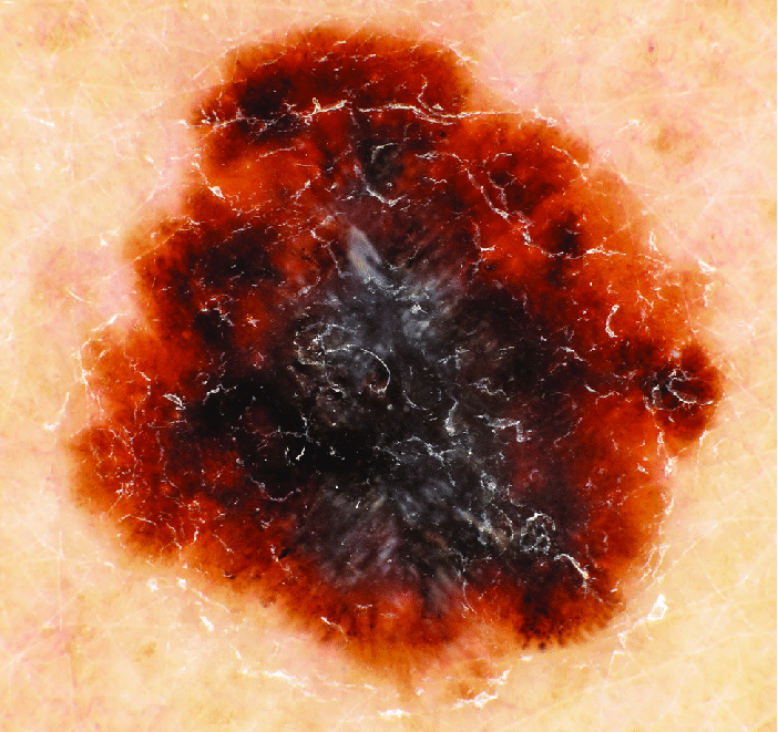 Abb.: Dermatoskopisches Bild